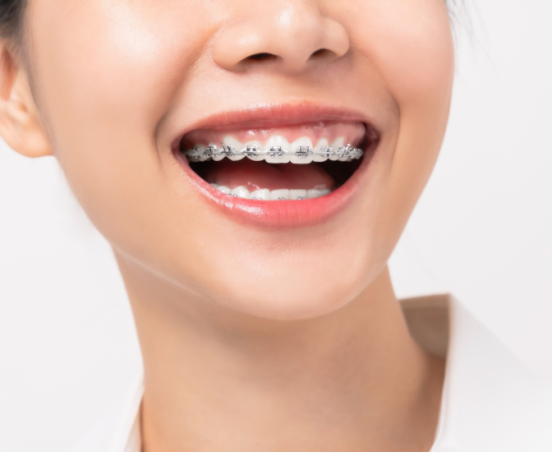 Aparat ortodontyczny – porady dla nowych użytkowników