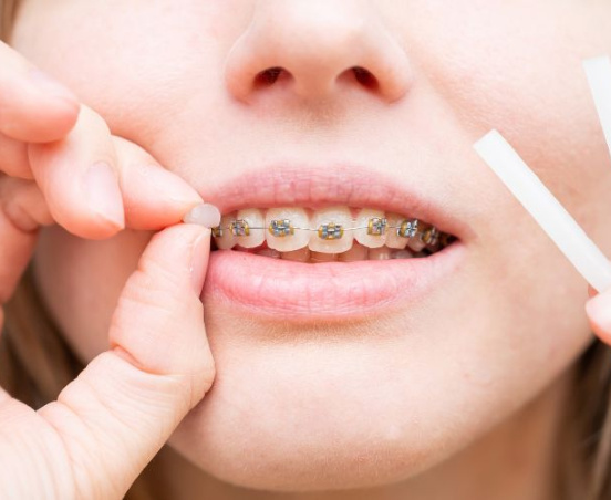 Wosk ortodontyczny – jak go używać?
