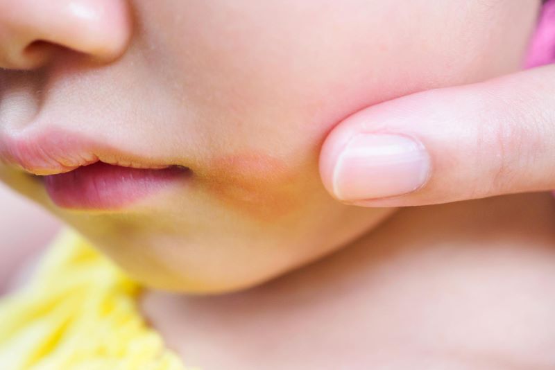 objawy alergii na pastę do zębów