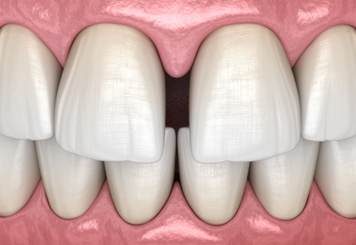Diastema - na czym polega?