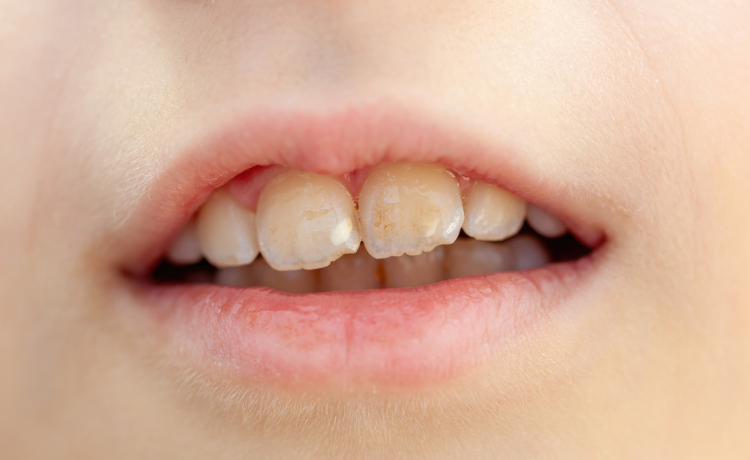 Jak wyleczyć próchnicę bez dentysty?