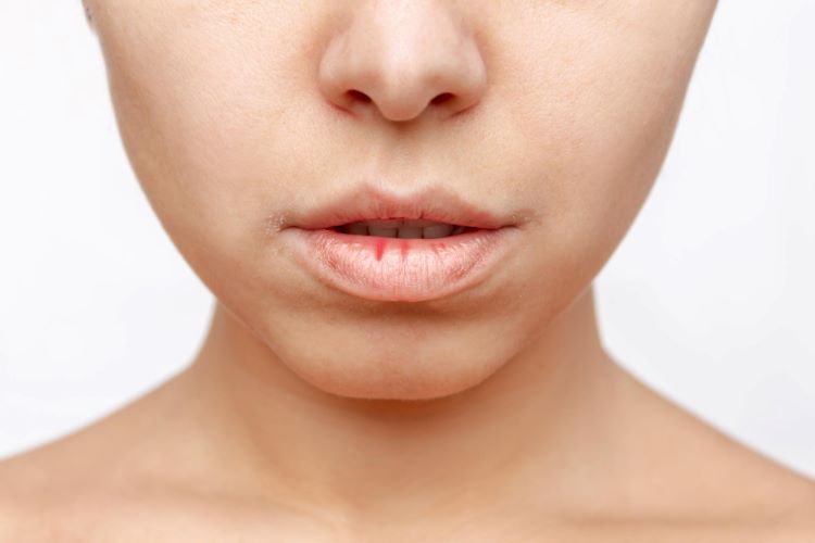 kserostomia - suchośćw ustach