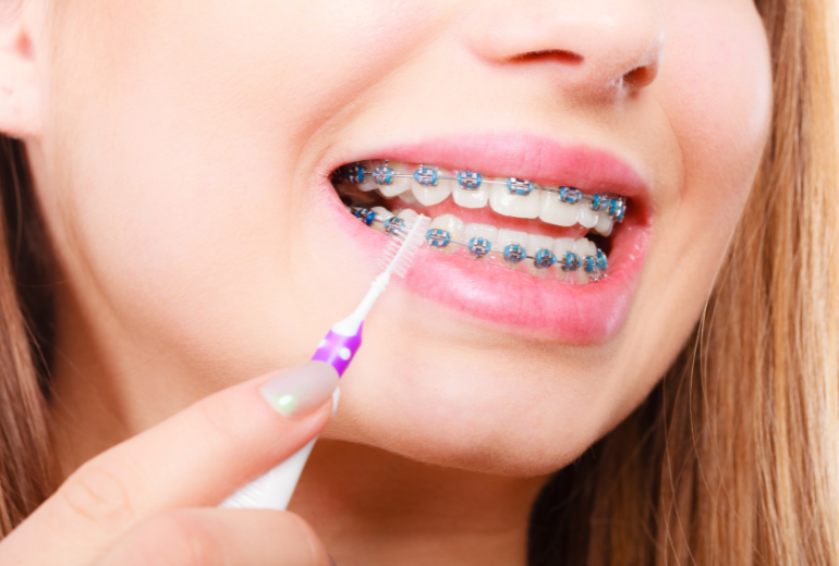 Jak czyścić zęby z aparatem ortodontycznym?