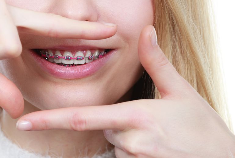 Wosk ortodontyczny - jak używać?