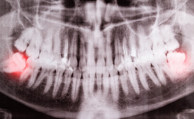 Ząb zatrzymany - objawy